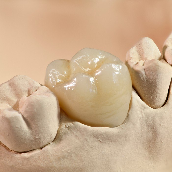 dental crown example