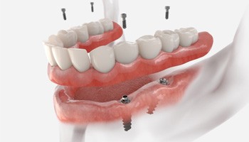 a digital illustration of a denture being placed atop implants 
