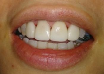 after porcelain veneers