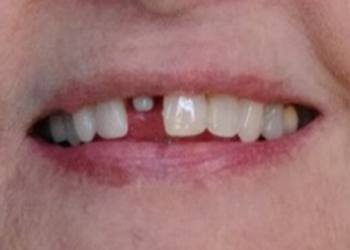 missing crown on tooth