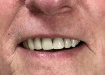 smile after 6 ceramic crowns were placed
