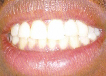 smile after implant was placed where missing tooth was