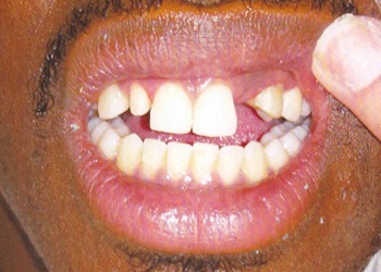 smile with missing upper tooth