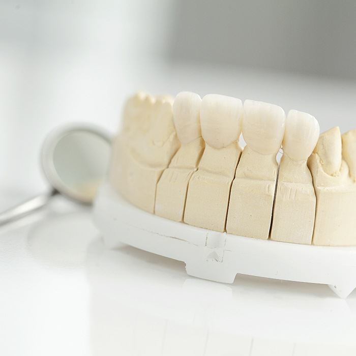 dental bridge example