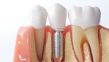 a model showing how a dental implant works