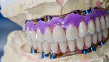 a dental prosthetic anchored to implants