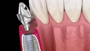 a digital illustration of an abutment 