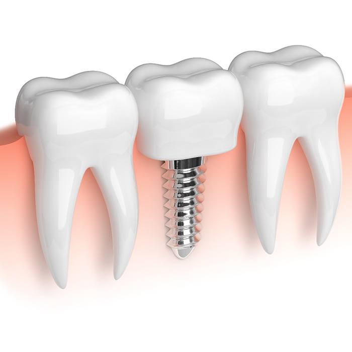 Graphic highlighting dental implant post in gums