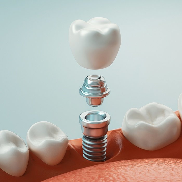 computer illustration of dental implant in Charlottesville