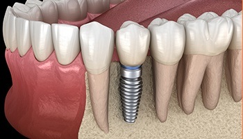 Computer illustration of implant