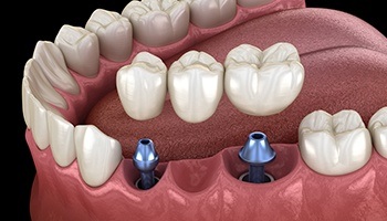 computer illustration of multiple implant