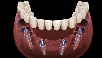 computer illustration of complete missing implants