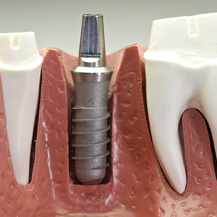 Model of a titanium dental implant.