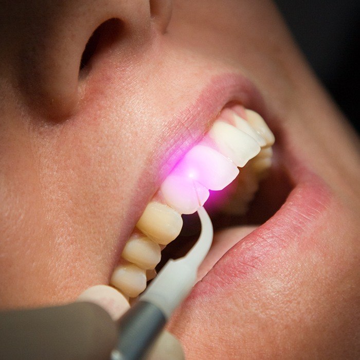 soft tissue laser used on woman's smile