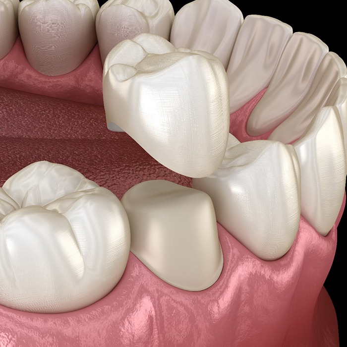 3D model of smile with one dental crown 