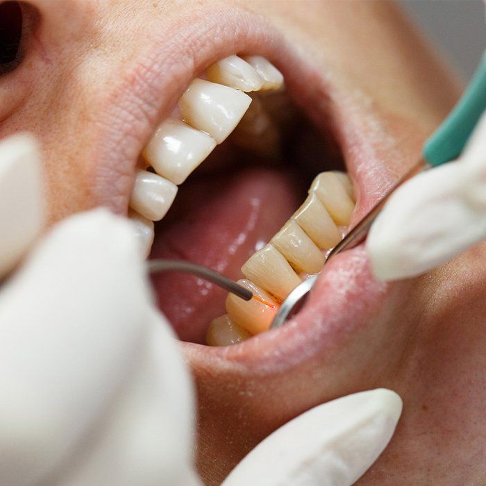 soft tissue laser being used in mouth