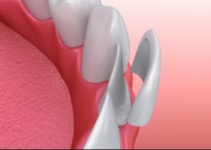 3D Image of a veneer being placed on a front tooth