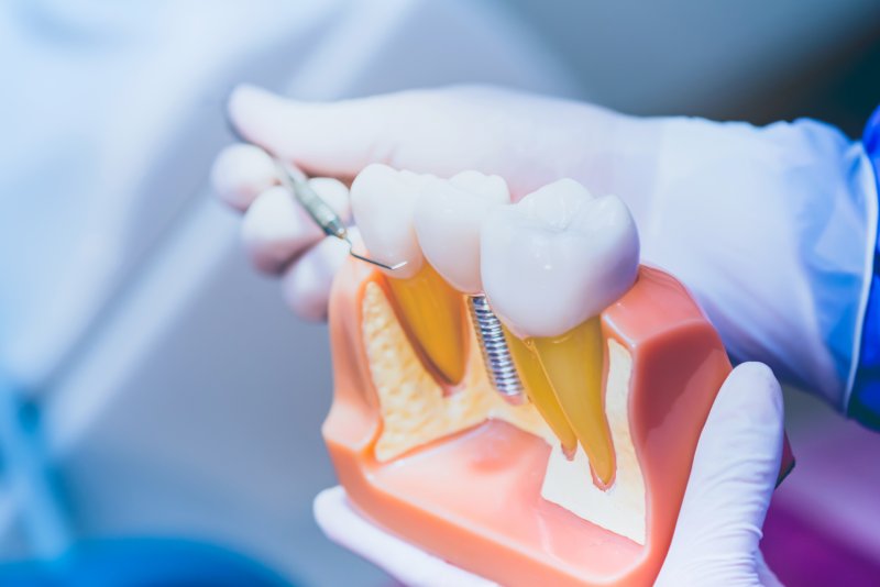 dentist holding dental implant model