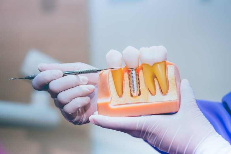 patient holding dental implant model