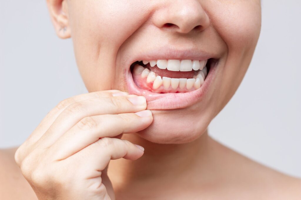 Nose-to-shoulder view of woman pulling down lower lip to reveal red gums